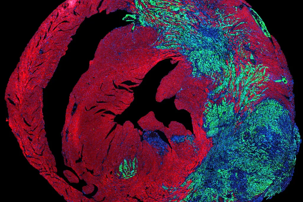 Image of lung cancer cells (in green) growing in a heart, in which cardiomyocytes are stained in red and uclei are stained in blue.